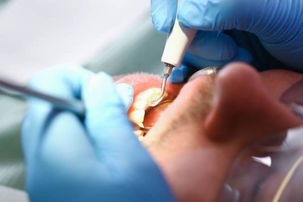 Best Emergency Dental Care for Broken or Chipped Teeth in Birch Run, MI