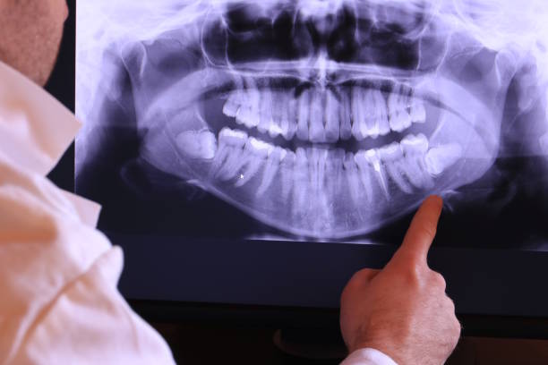 Best Emergency Wisdom Teeth Removal in Birch Run, MI